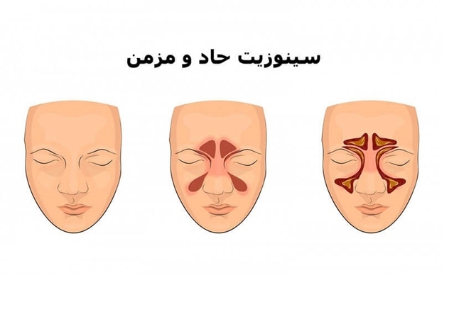 آیا ۹۵ درصد بیماران مبتلا به سینوزیت مزمن بدون نیاز به جراحی درمان میشوند آیا ۹۵ درصد بیماران مبتلا به سینوزیت مزمن بدون نیاز به جراحی درمان میشوند